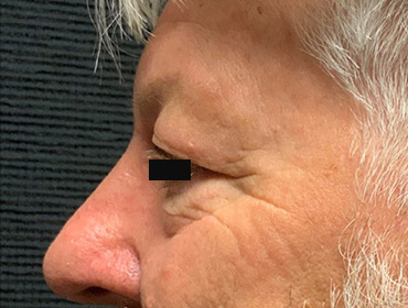 Patient #79785: Blepharoplasty Before Image