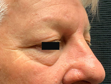 Patient #79785: Blepharoplasty Before Image