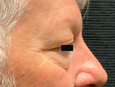 Patient #79785: Blepharoplasty Before Image