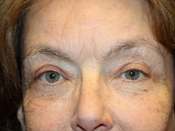 Patient #92721-1: Facelift, Fat Injections, Blepharoplasty, & Neck Lift After Image
