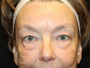 Patient #92721-1: Facelift, Fat Injections, Blepharoplasty, & Neck Lift Before Image