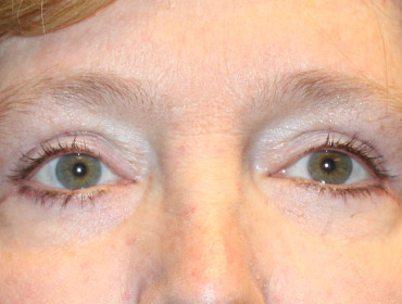 Patient #23131: Blepharoplasty After Image
