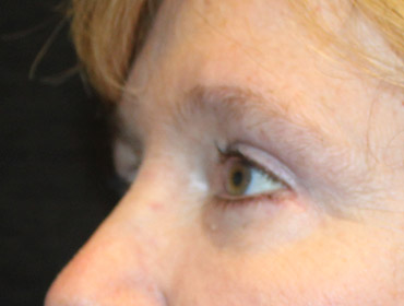 Patient #23131: Blepharoplasty After Image