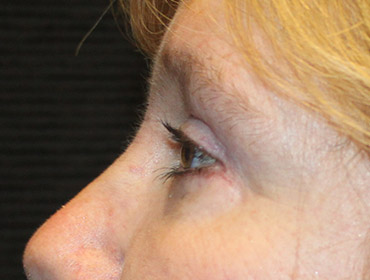 Patient #23131: Blepharoplasty After Image