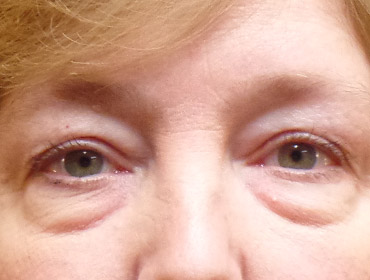 Patient #23131: Blepharoplasty Before Image