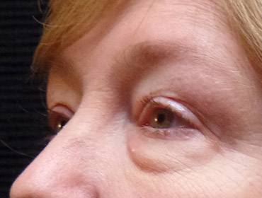 Patient #23131: Blepharoplasty Before Image