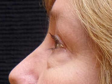 Patient #23131: Blepharoplasty Before Image