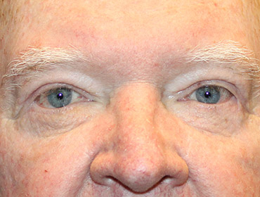 Patient #24742: Blepharoplasty After Image