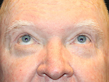 Patient #24742: Blepharoplasty After Image
