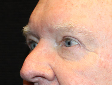 Patient #24742: Blepharoplasty After Image
