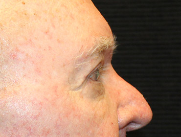 Patient #24742: Blepharoplasty After Image