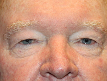 Patient #24742: Blepharoplasty Before Image