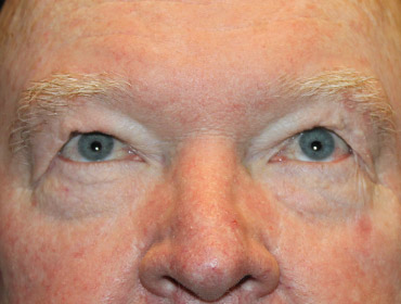 Patient #24742: Blepharoplasty Before Image