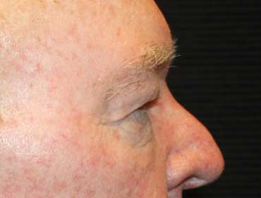 Patient #24742: Blepharoplasty Before Image