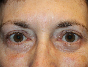 Patient #48846: Blepharoplasty After Image