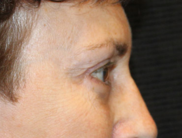 Patient #48846: Blepharoplasty After Image