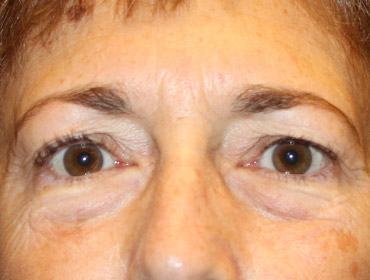 Patient #48846: Blepharoplasty Before Image