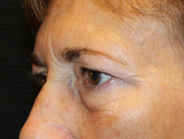 Patient #48846: Blepharoplasty Before Image