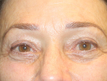 Patient #55296: Blepharoplasty After Image