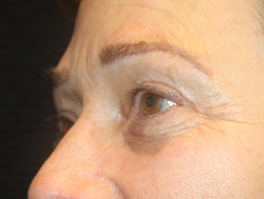 Patient #55296: Blepharoplasty After Image