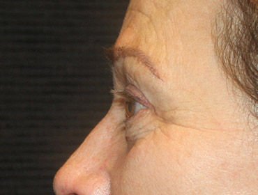 Patient #55296: Blepharoplasty After Image