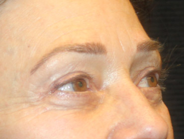 Patient #55296: Blepharoplasty After Image