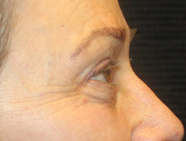 Patient #55296: Blepharoplasty After Image