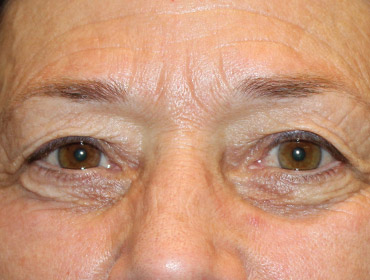 Patient #55296: Blepharoplasty Before Image