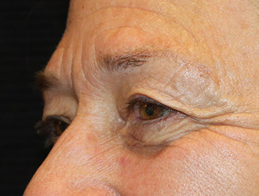 Patient #55296: Blepharoplasty Before Image