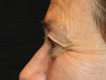 Patient #55296: Blepharoplasty Before Image