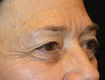 Patient #55296: Blepharoplasty Before Image