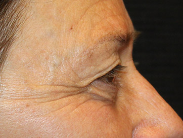 Patient #55296: Blepharoplasty Before Image