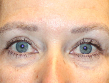 Patient #87496: Blepharoplasty After Image