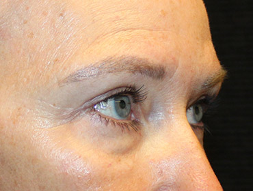 Patient #87496: Blepharoplasty After Image