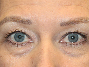 Patient #87496: Blepharoplasty Before Image