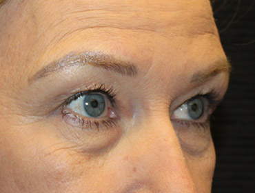 Patient #87496: Blepharoplasty Before Image