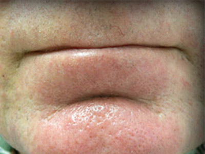 Patient #22416: IPL for Blood Vessels After Image