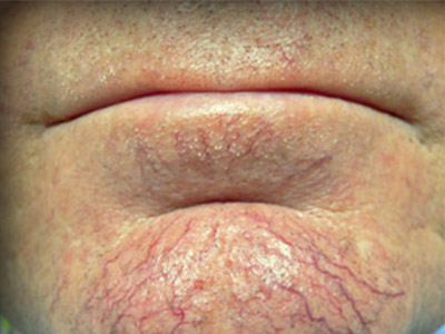 Patient #22416: IPL for Blood Vessels Before Image