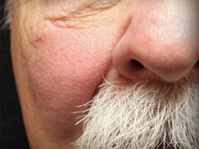 Patient #12562: IPL for Blood Vessels After Image