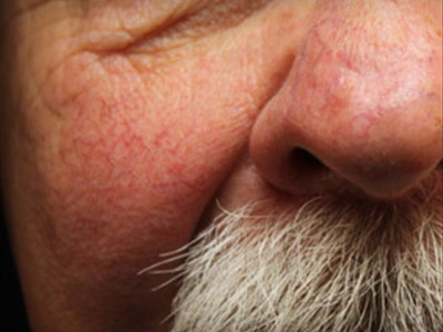 Patient #12562: IPL for Blood Vessels Before Image