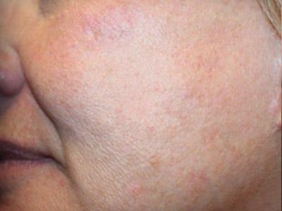 Patient #85093: IPL for Brown Spots Before Image