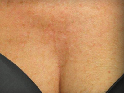 Patient #88573: IPL for Brown Spots After Image