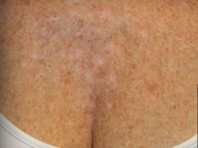 Patient #88573: IPL for Brown Spots Before Image