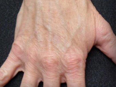 Patient #35138: IPL for Brown Spots After Image