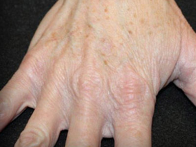 Patient #35138: IPL for Brown Spots Before Image