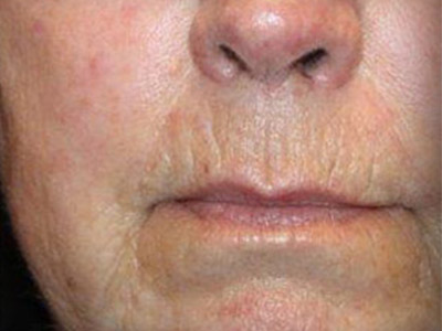 Patient #54386: IPL for Blood Vessels After Image