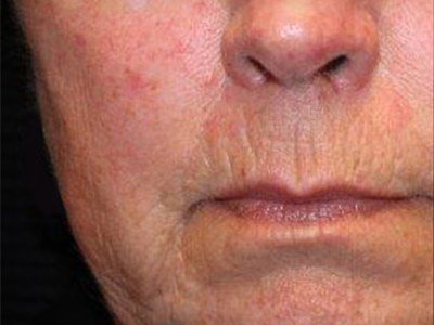 Patient #54386: IPL for Blood Vessels Before Image