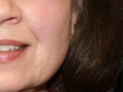 Patient #18637: IPL for Blood Vessels After Image