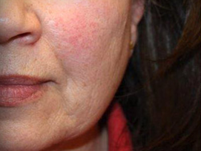 Patient #18637: IPL for Blood Vessels Before Image