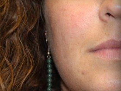 Patient #83969: IPL for Blood Vessels After Image